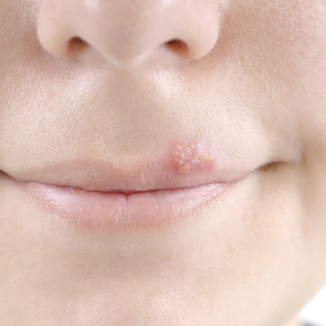 Cold Sores (Herpes Simplex Virus)