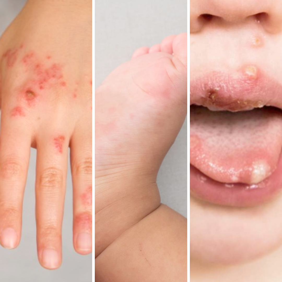 Hand, Foot, and Mouth Disease (HFMD)