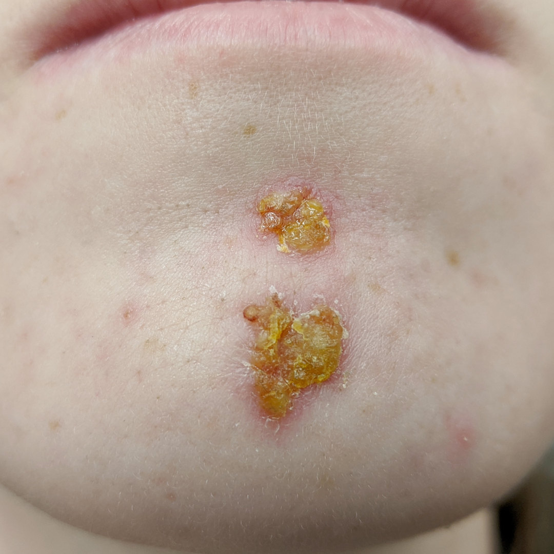 Impetigo