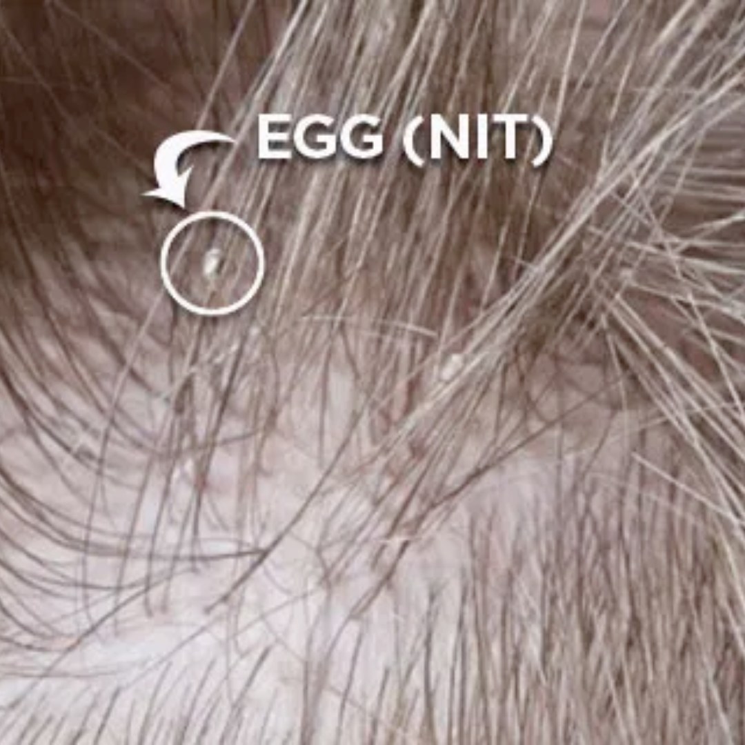 Lice