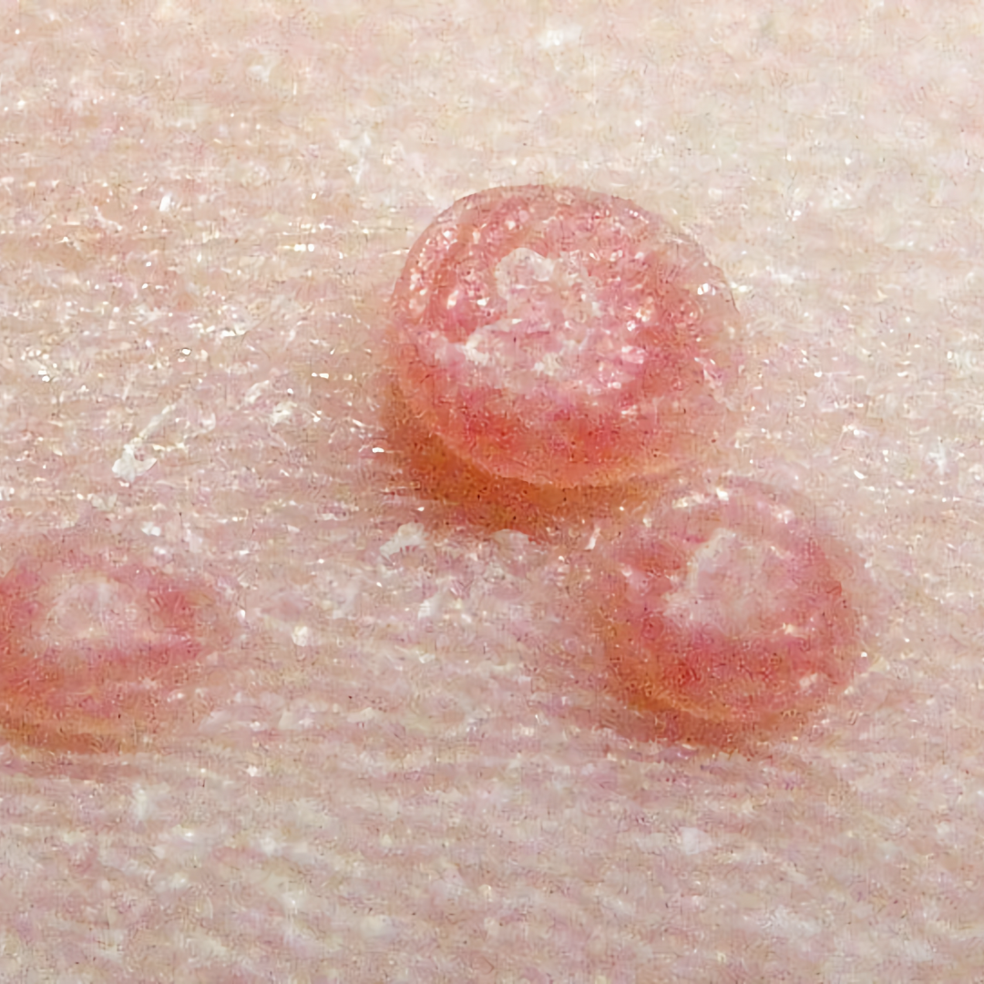 Molluscum Contagiosum