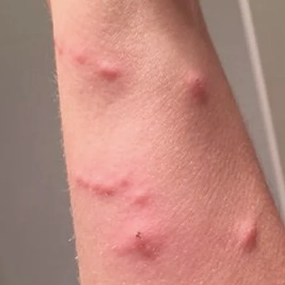 Poison Ivy (or Oak/Sumac)