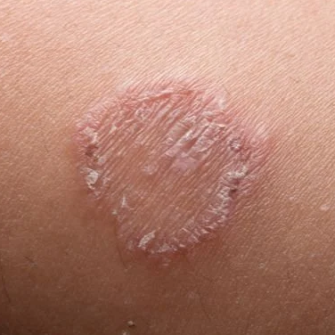 Ringworm (Tinea)