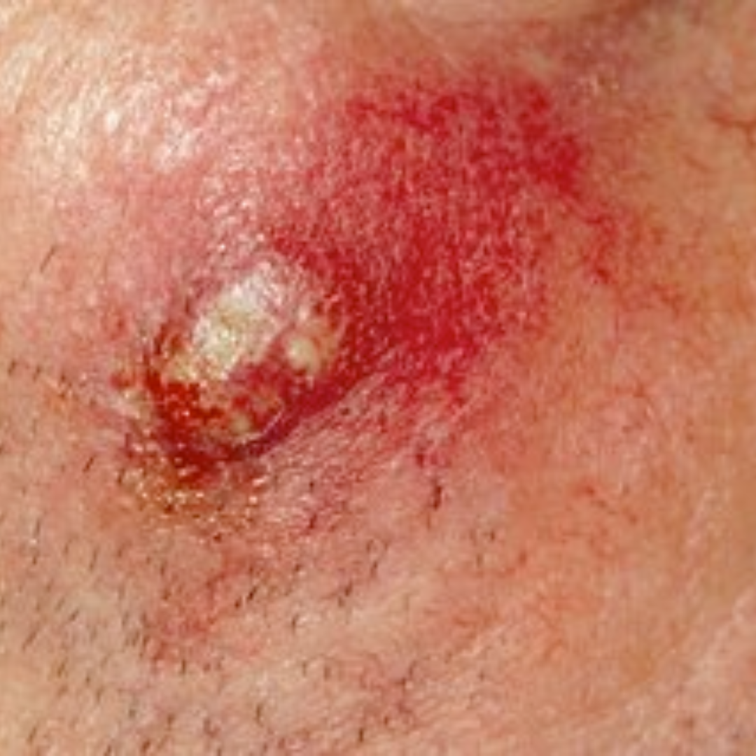 Staph Infection / MRSA