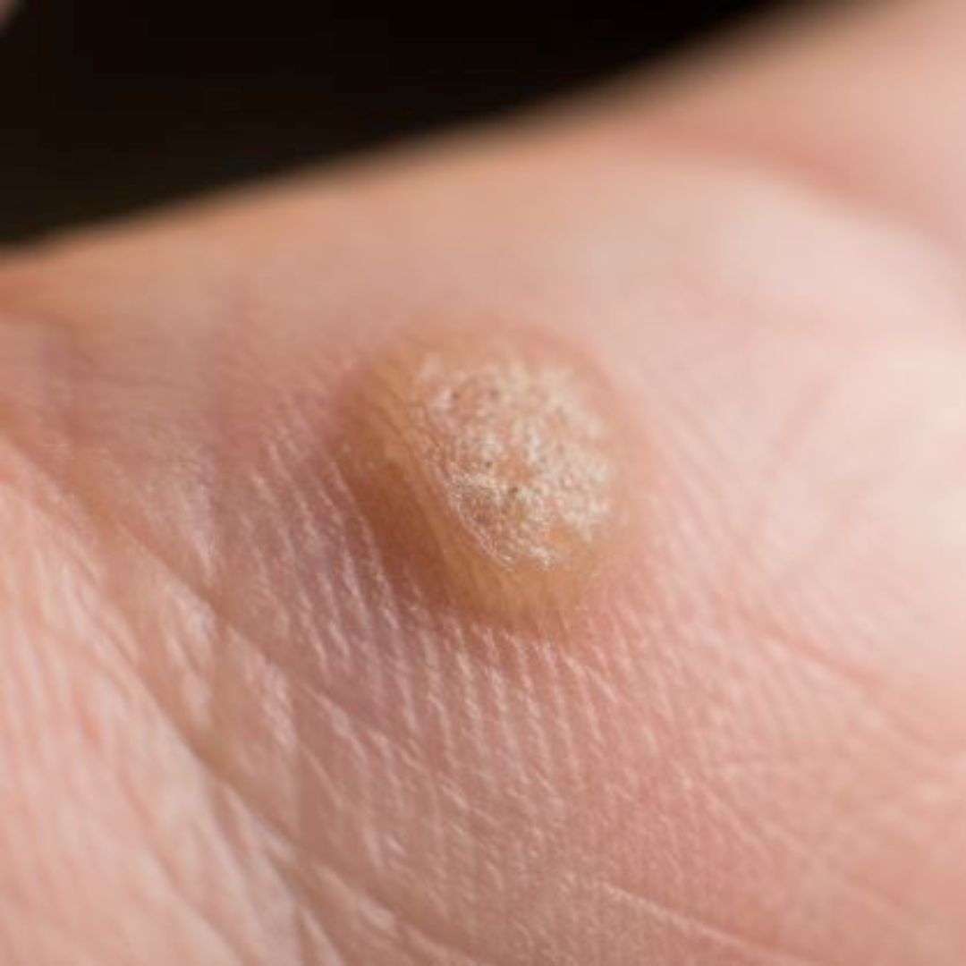 Warts (Common or Plantar)